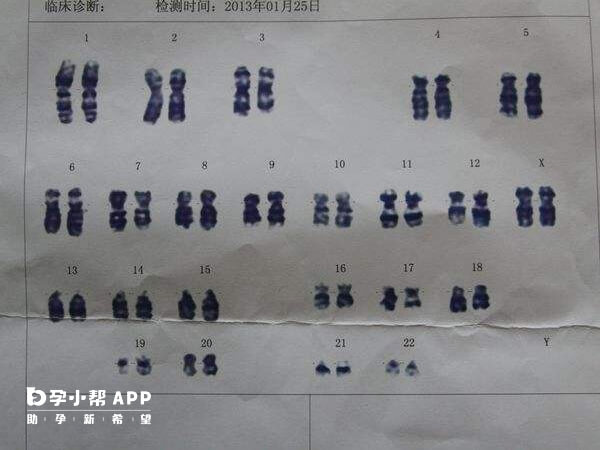 染色體47xxx是超雌綜合徵