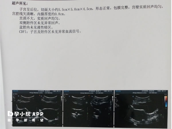 内膜厚度在8毫米最适合胚胎移植