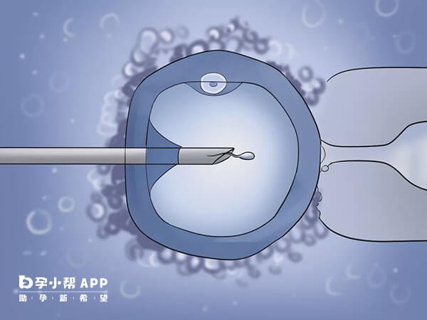 二代试管注射精子到卵泡