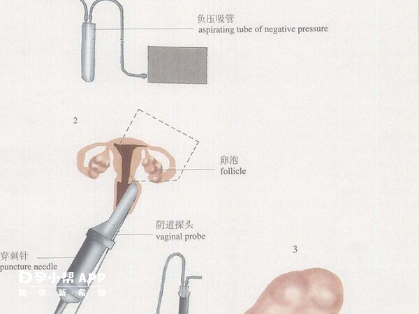 取卵手术示意图