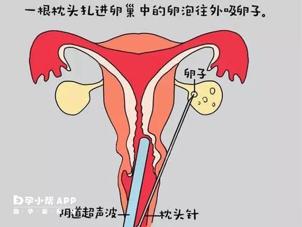 做试管取卵手术