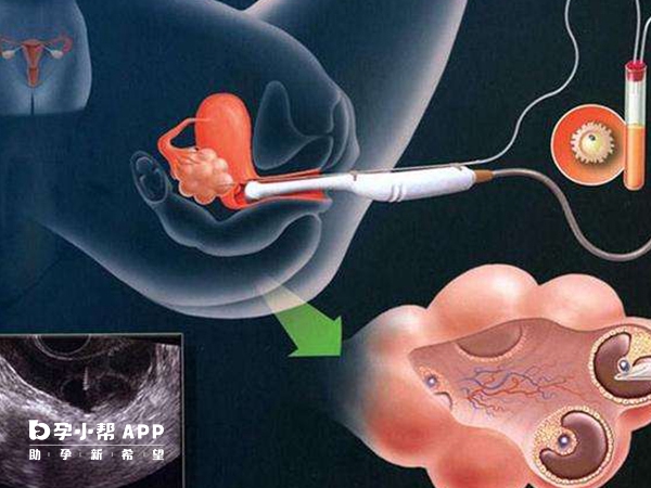 試管取卵分為無痛和有痛的