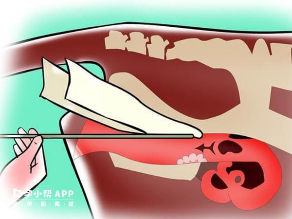 用导管进行人工授精