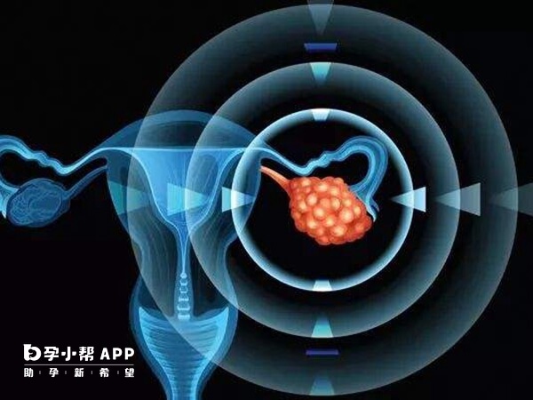 卵巢早衰患者激素水平较低