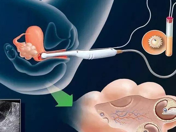 穿刺针取卵
