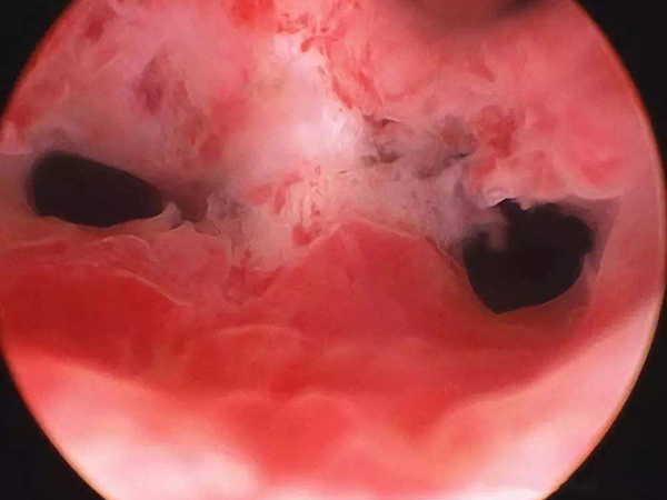 宫腔粘连手术需要使用宫腔镜