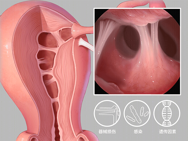 严重宫腔粘连的女性不能做试管婴儿