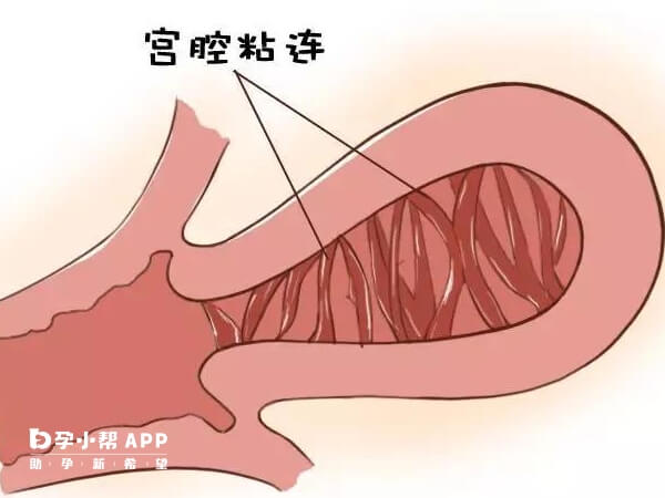 宫腔粘连不能做试管