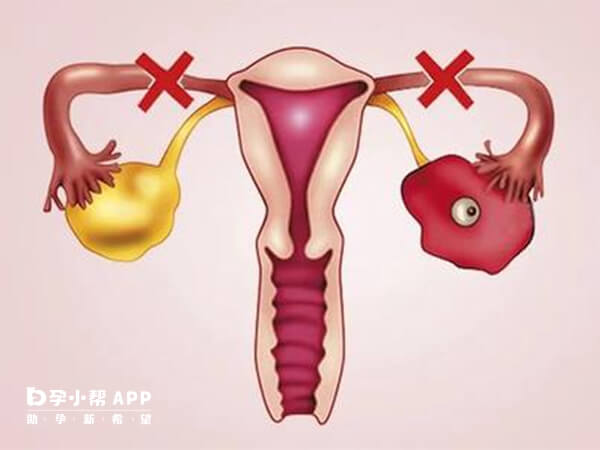 输卵管堵塞试管移植后不会宫外孕