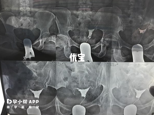滄州二院做輸卵管造影很好