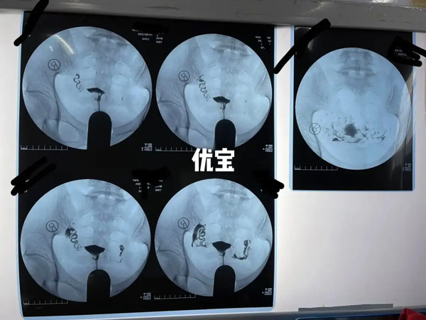 输卵管通畅促排后易怀孕