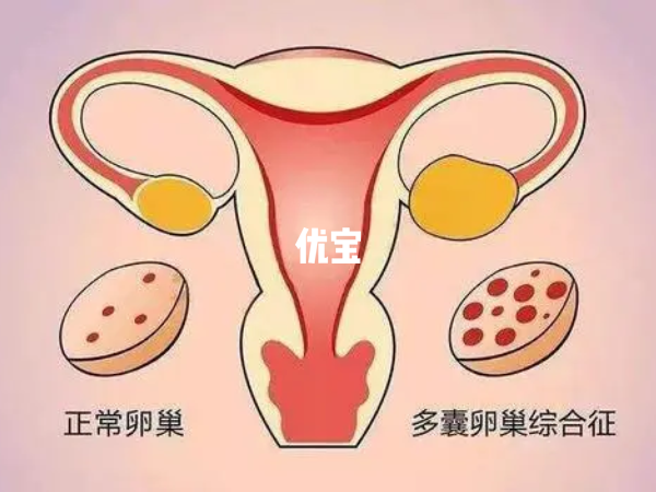 多囊卵巢综合征是内分泌紊乱