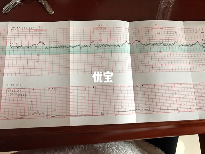 脐带绕颈要注意胎动