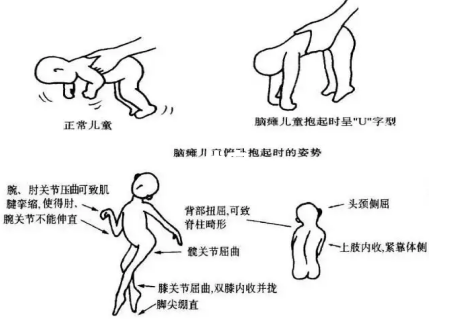 脑瘫宝宝的异常姿势图