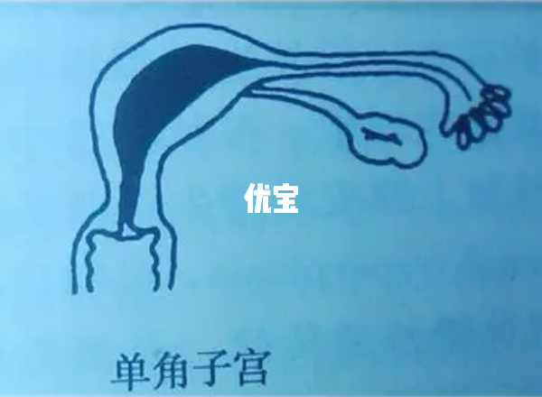 单角子宫能怀孕生子