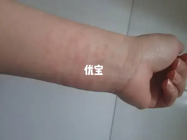 红斑痣是比较常见的