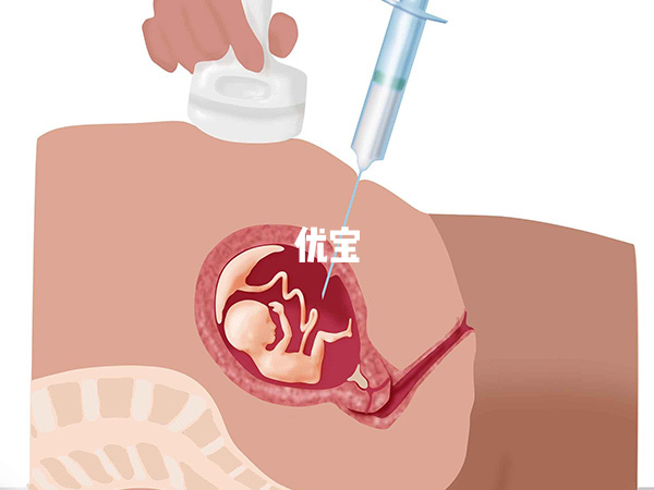 羊水穿刺的通过率高