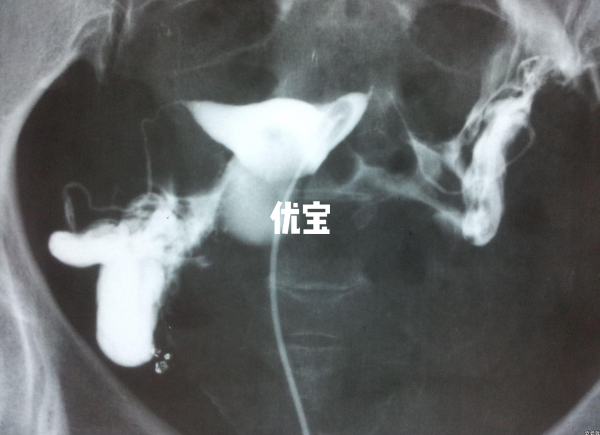 太原输卵管造影费用不高