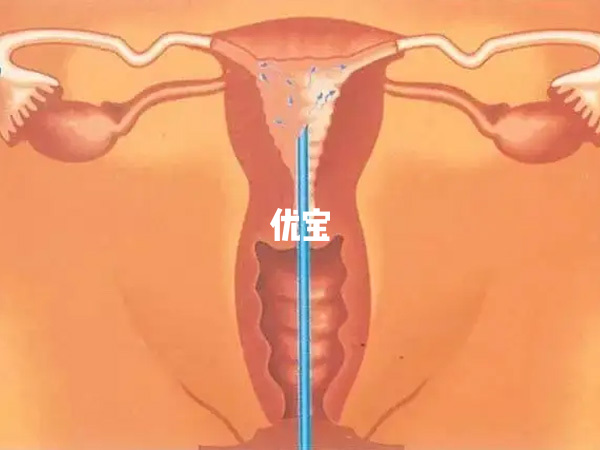 人工授精是将精子直接注入女性宫腔