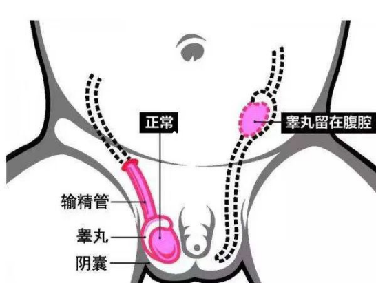 隐睾的症状