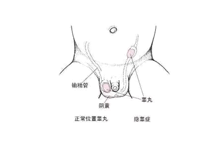 隐睾与正常位置睾丸对比图