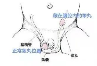 隐睾症是常见男性生殖系统疾病