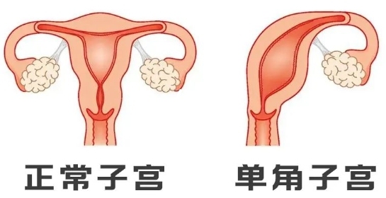 单角子宫与正常子宫对比图