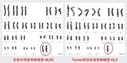 Turner综合征染色体类型