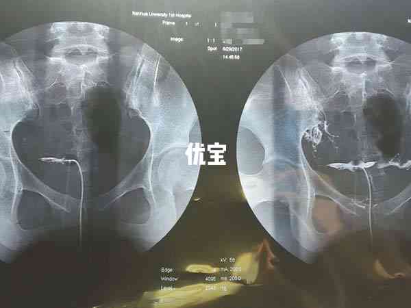 输卵管造影检查不能超过时间