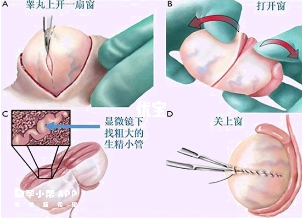 显微取精手术原理