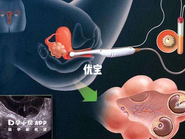 无痛取卵是比较安全的