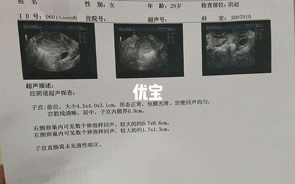 测卵泡的最佳时间是月经后第10天