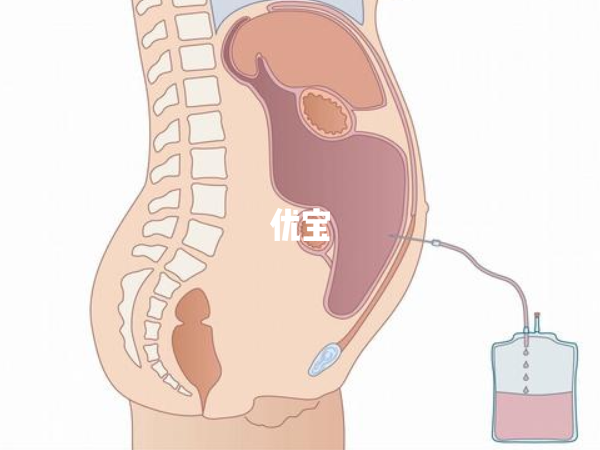 取卵后腹水70mm的恢复时间较长