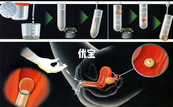 做过供精人工授精的患者不少