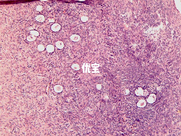 34岁基础卵泡每侧20个以上可能是多囊