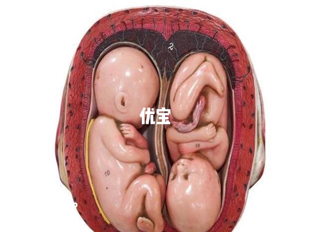 試管懷雙胎有風險