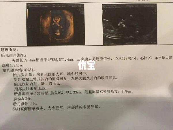 孕12周nt检查报告单